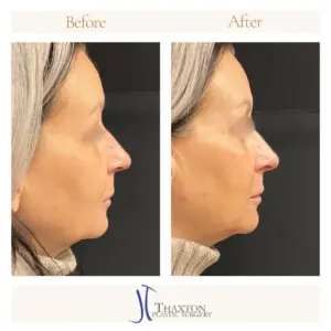 Dr. Jeff Thaxton Face Filler Result