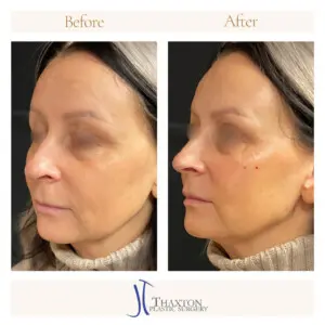 Dr. Jeff Thaxton Face Filler Result