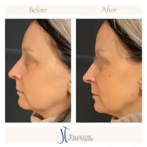 Dr. Jeff Thaxton Face Filler Result