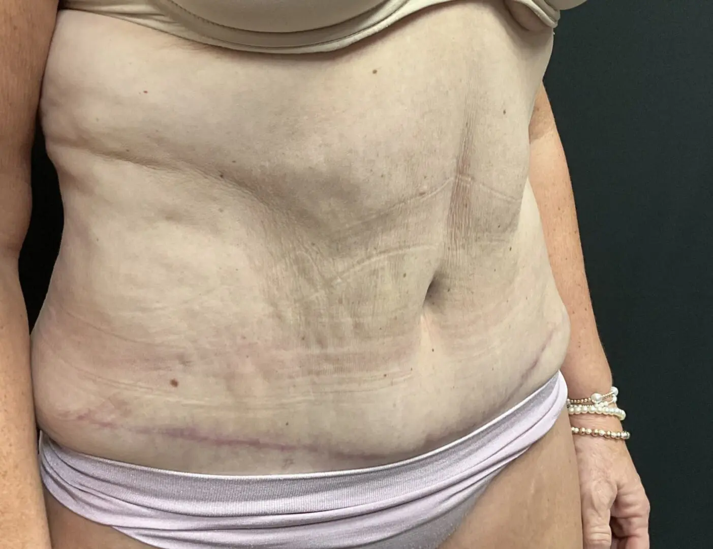 Jeff Thaxton MD Tummy Tuck Result