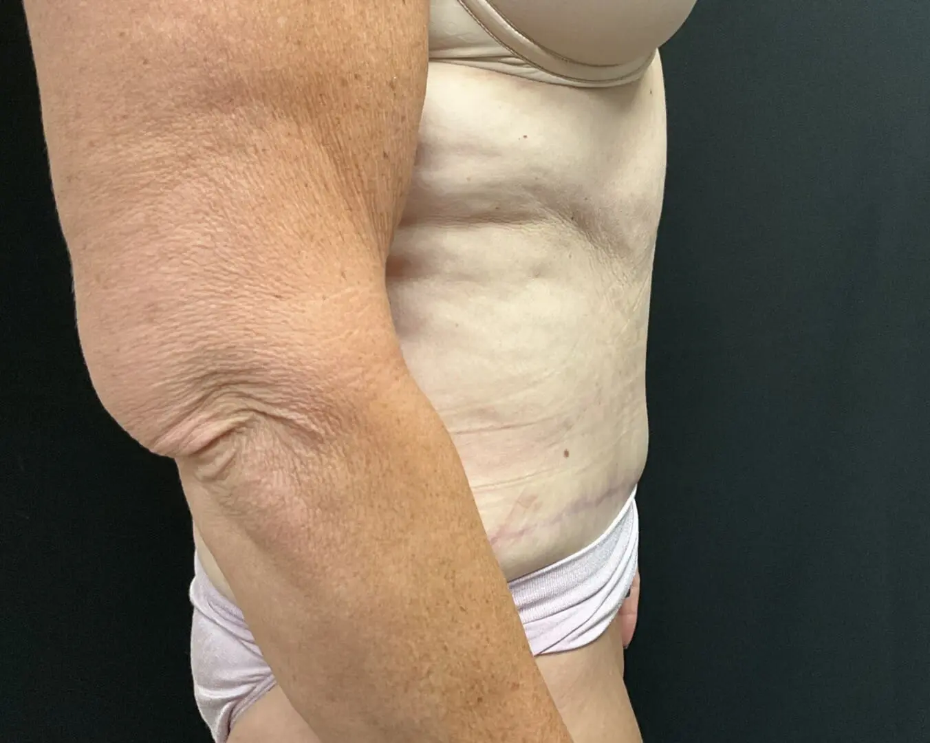 Jeff Thaxton MD Tummy Tuck Result