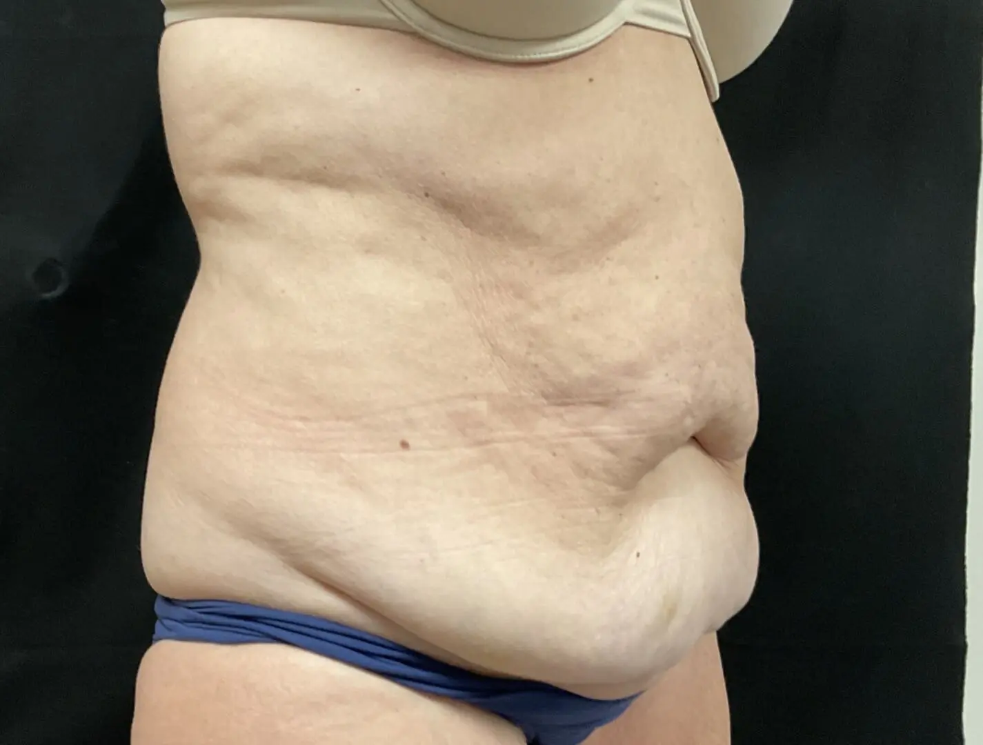 Jeff Thaxton MD Tummy Tuck Result