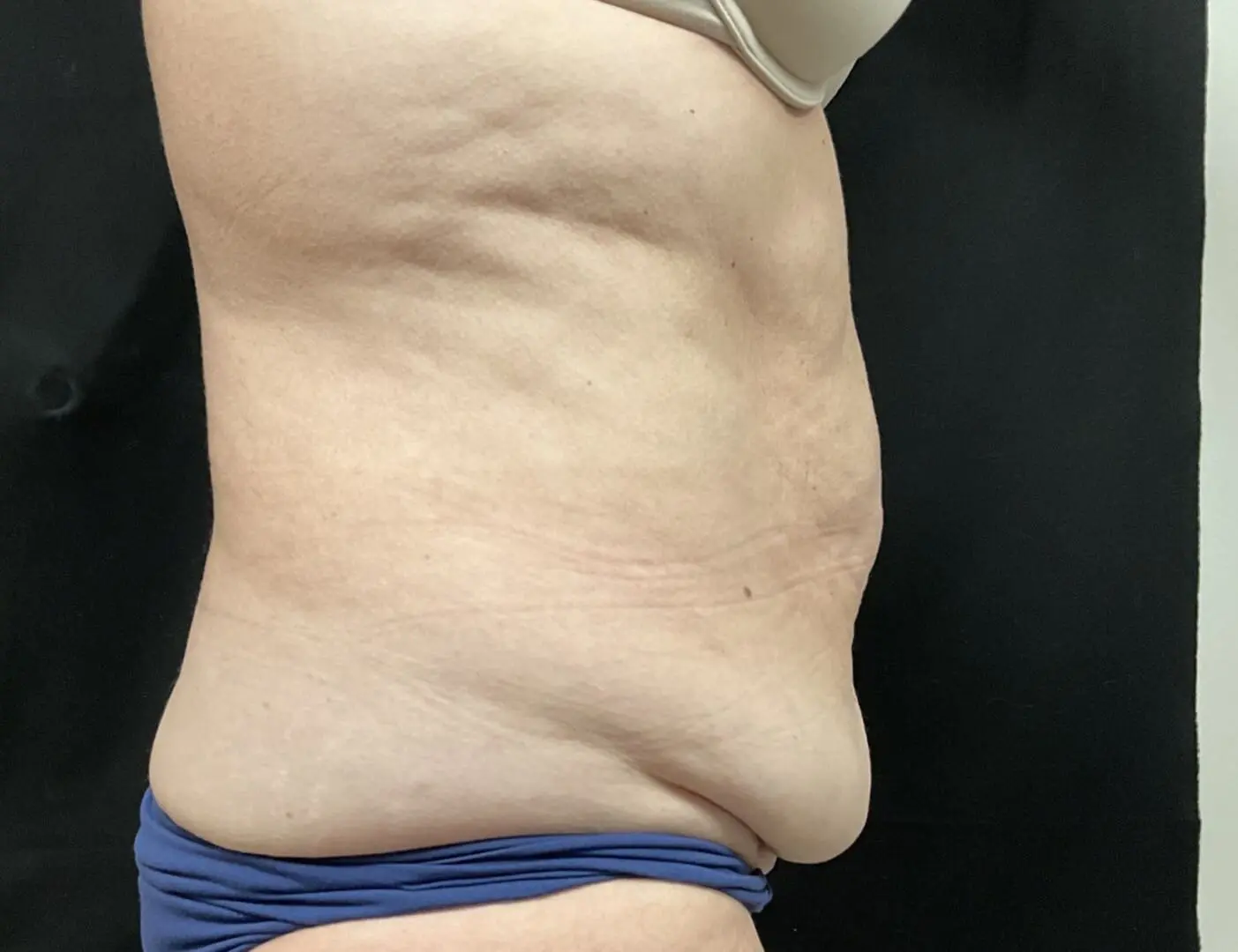 Jeff Thaxton MD Tummy Tuck Result