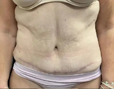 Jeff Thaxton MD Tummy Tuck Result