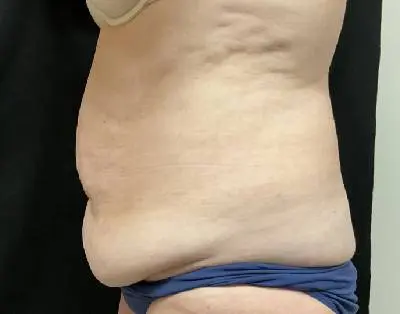 Jeff Thaxton MD Tummy Tuck Result