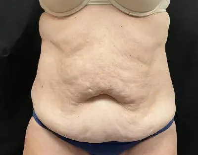 Jeff Thaxton MD Tummy Tuck Result