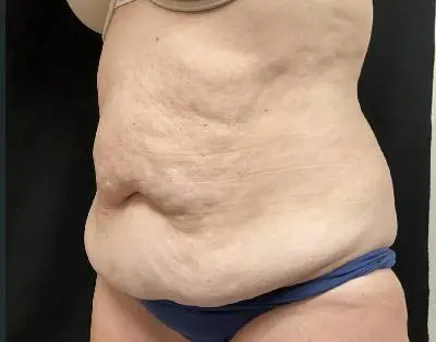 Jeff Thaxton MD Tummy Tuck Result