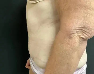 Jeff Thaxton MD Tummy Tuck Result