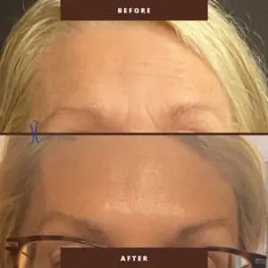 Frontal Forehead Botox Result