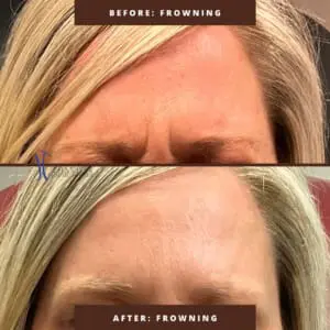 Dr. Jeff Thaxton Botox Result