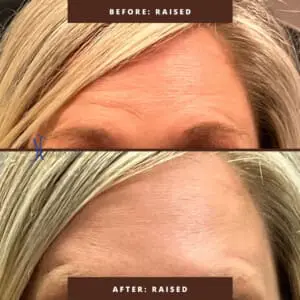 Dr. Jeff Thaxton Botox Result