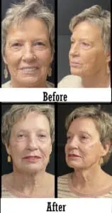 face filler before after charleston wv