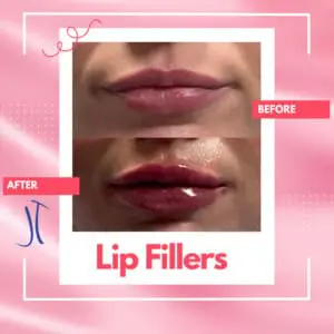 Frontal Profile Dr. Jeff Thaxton Lip Filler Result