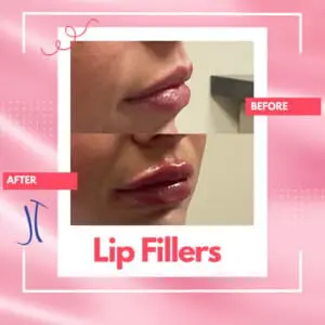 Right Profile Dr. Jeff Thaxton Lip Filler Result