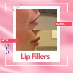 Right Profile Dr. Jeff Thaxton Lip Filler Result