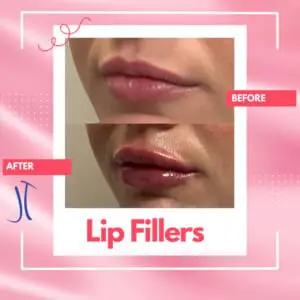Left Profile Dr. Jeff Thaxton Lip Filler Result