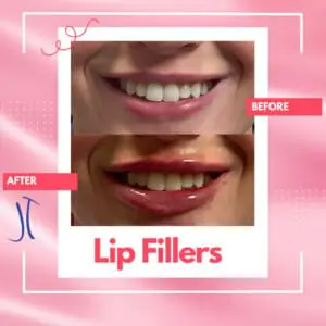 Front Profile Dr. Jeff Thaxton Lip Filler Result