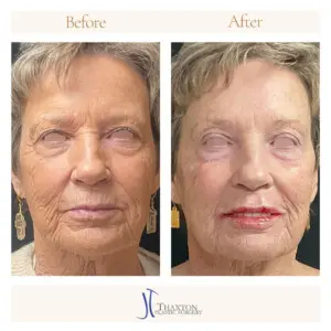 Frontal view injectables result comparison