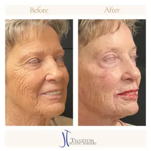 Smiling frontal rejuvenation before and after
