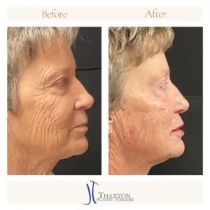 Right profile injectables treatment comparison