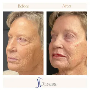 Oblique view facial filler results