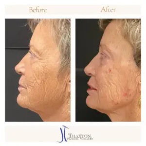 Left profile facial rejuvenation comparison