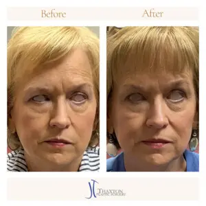 Botox Before and After Relaxed