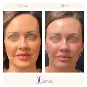 Frontal before and after facial filler result