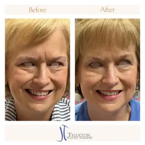 Botox Before and After Smiling