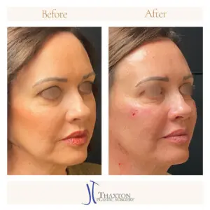 Three quarter view facial filler comparison