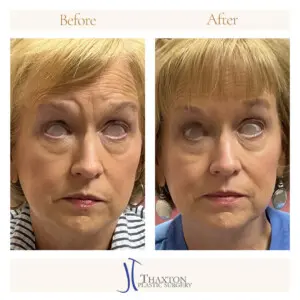 Botox Before and After Raised