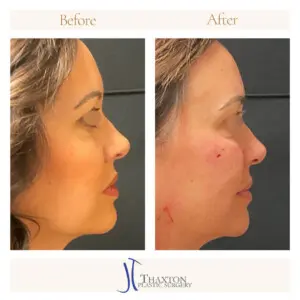 Side by side profile before and after