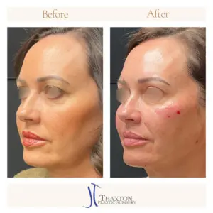 Oblique view before after facial filler