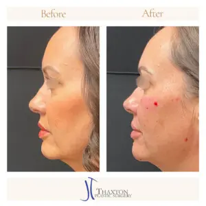 Profile comparison showing cheek filler results