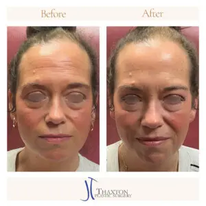 Forehead Botox Results Relaxed