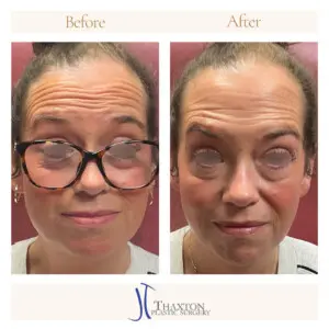Forehead Botox Results Raised