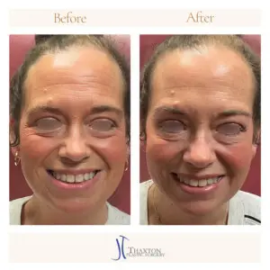 Forehead Botox Results Smiling