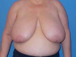 Breast Reduction Patient 2 - Before