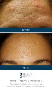 microneedling result