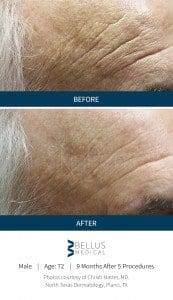 microneedling result