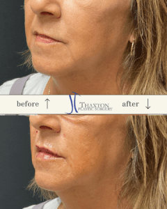 Lip filler before after Charleston WV