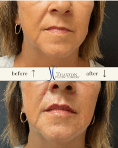 shows before after lip filler charleston wv