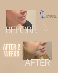 Lip filler injections Charleston WV before after