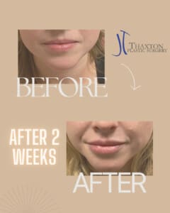 Lip filler injections before & after 2 weeks
