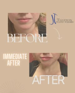 Lip filler injections Charleston WV