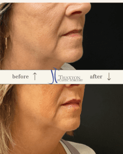 lip filler injections WV before & after