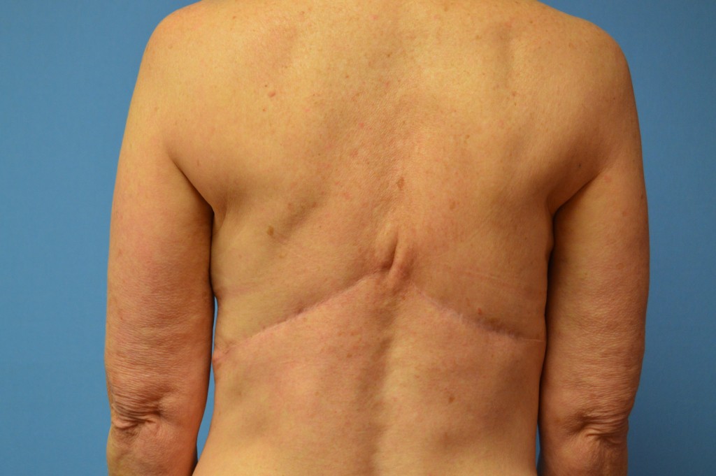 Breast Reconstruction Patient 7 - Revision, After Latissimus Flap