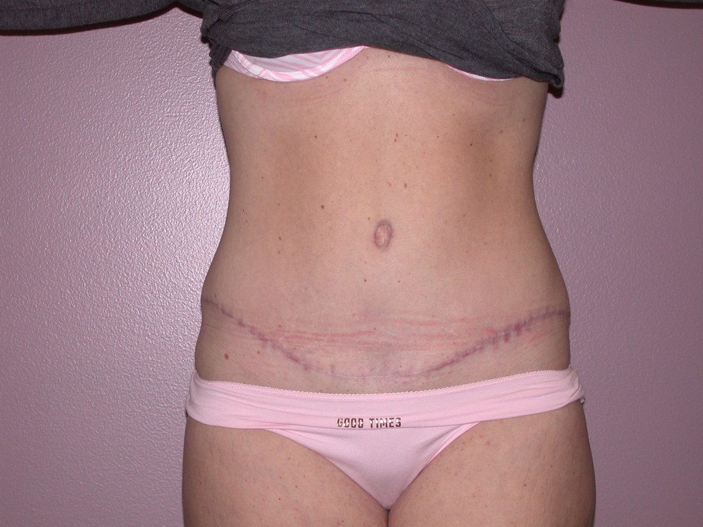 Abdominoplasty Patient 1 - After, View 1