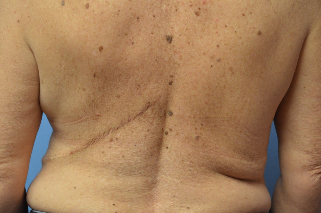 Breast Reconstruction Patient 6 - Delayed, After Latissimus Flap