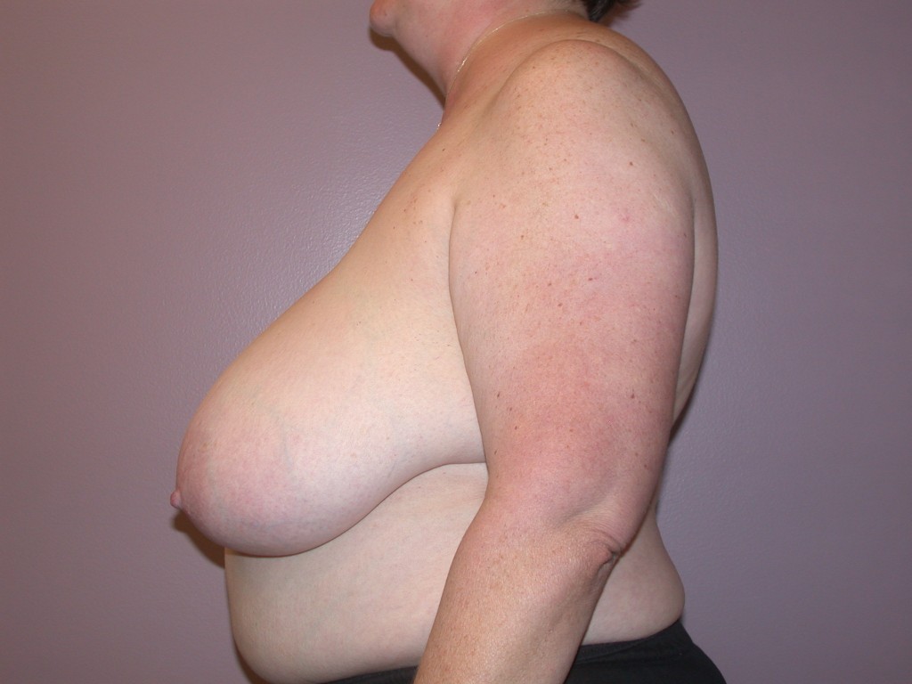 Breast Reduction Patient 3 - Before
